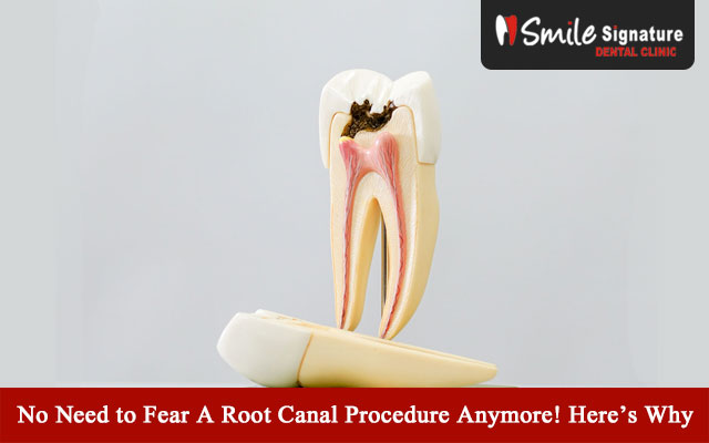 No Need to Fear A Root Canal Procedure Anymore! Here’s Why